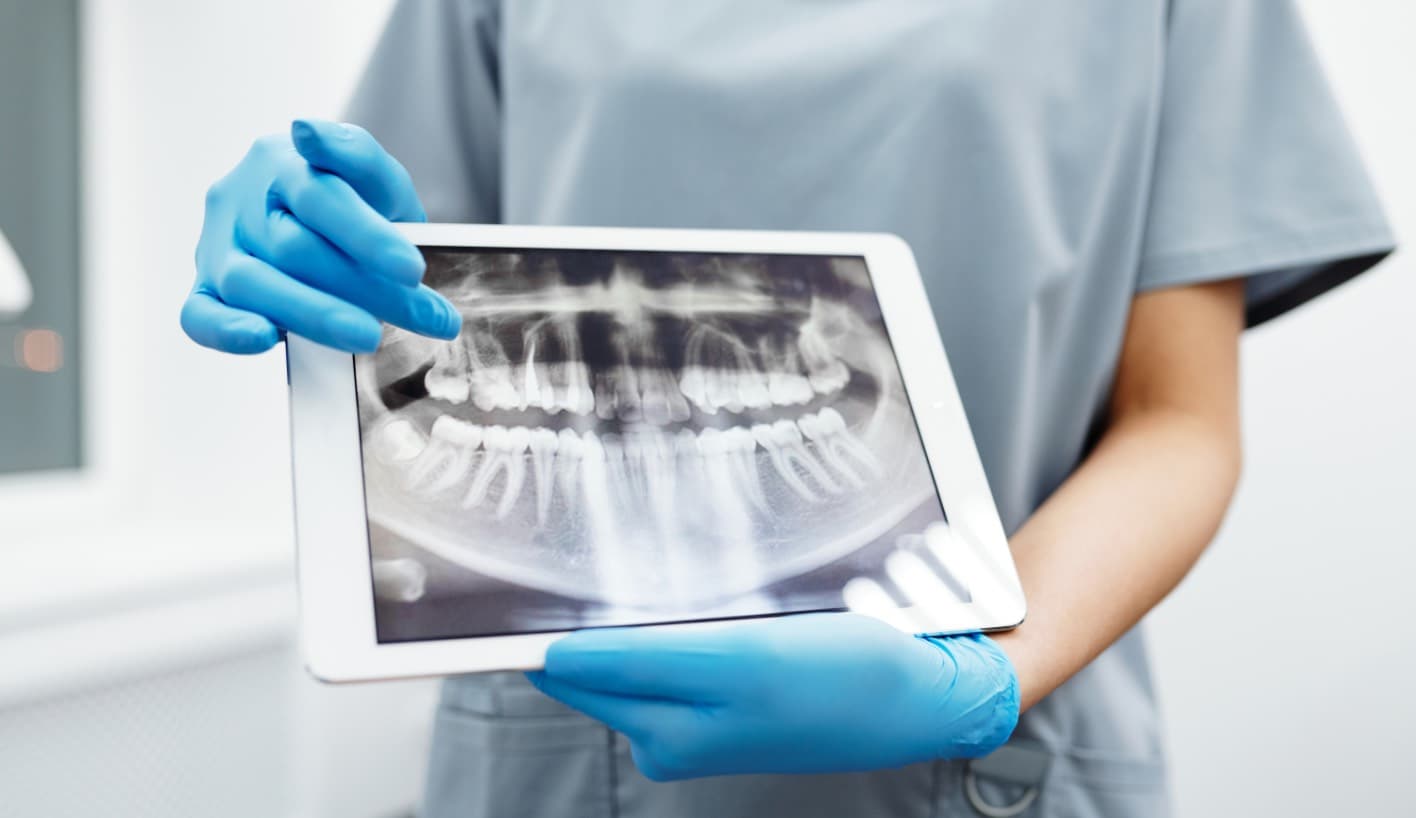 Dental Implants